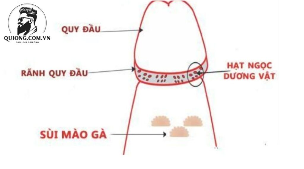 Chuỗi hạt ngọc ở dương vật: Triệu chứng và nguyên nhân