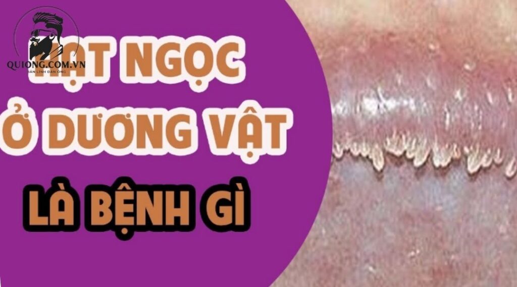 Chuỗi hạt ngọc trên dương vật