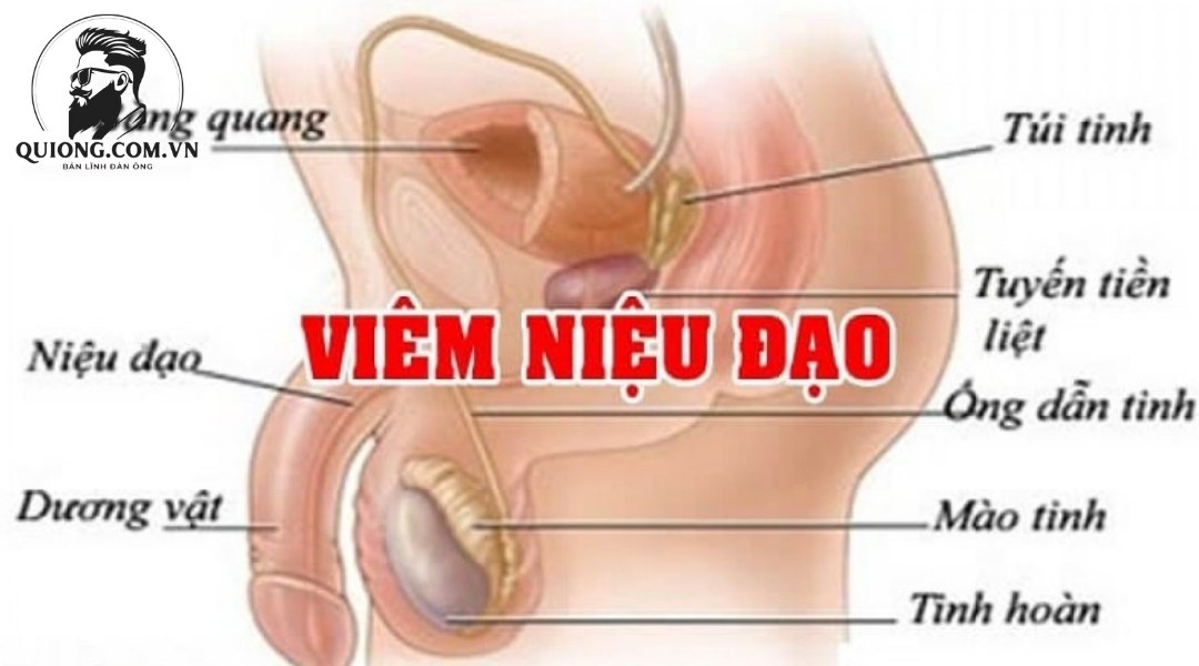 Nguyên nhân gây ra viêm niệu đạo