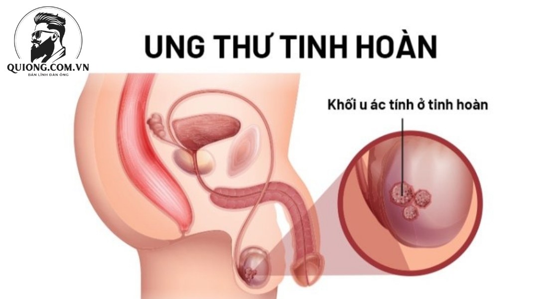 Ung thư tinh hoàn