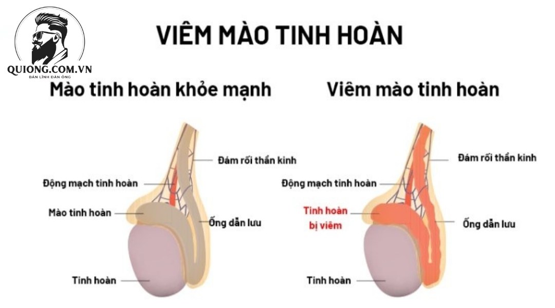 Viêm mào tinh hoàn